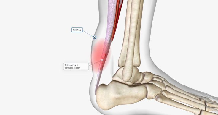 Danger of Achilles Tendon Rupture